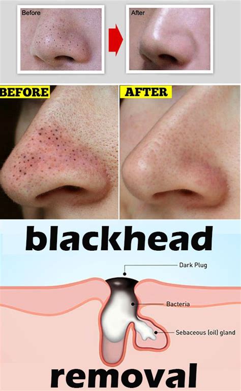 Warning These videos are not for the faint of heart. . Blackheads on private area video